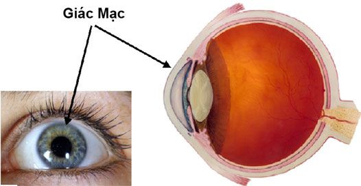 ĐẶC ĐIỂM LÂM SÀNG NHIỄM TRÙNG DO KÍNH TIẾP XÚC